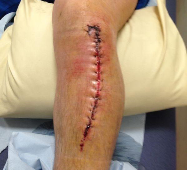 Richard Cowell's leg after receiving stitches